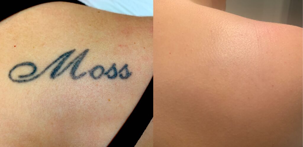 Full Laser tattoo removal treatment
