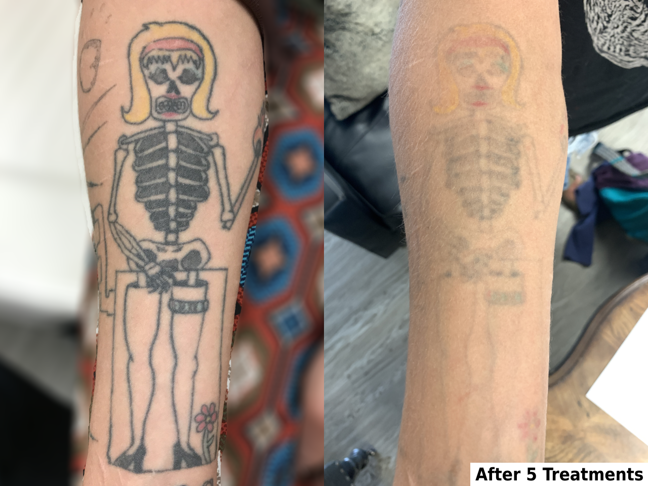 Tattoo Removal Before and After in Colorado, how tattoo removal works