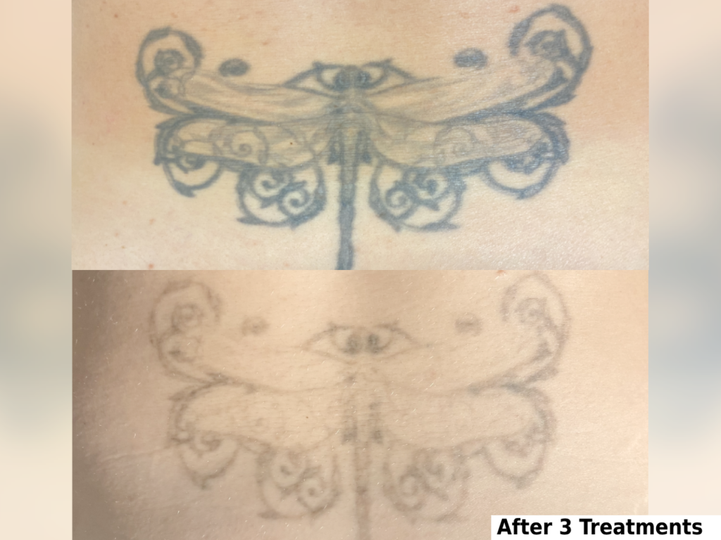 Black and grey before and after laser tattoo removal in Denver, Colorado