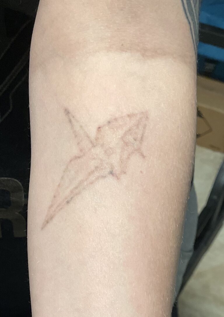After tattoo removal, tattoo removal aftercare