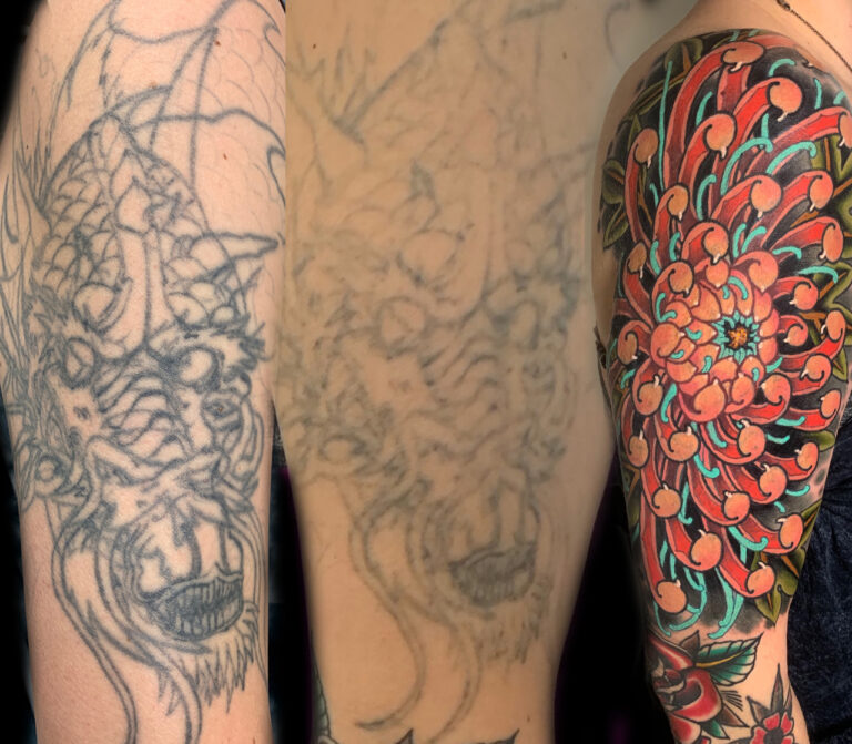 Tattoo removal for tattoo coverup Denver Colorado