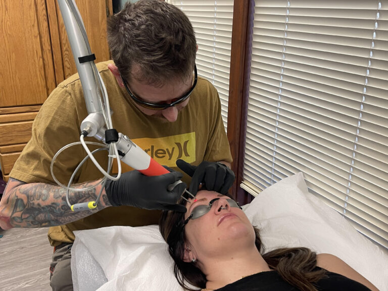 Microblading removal
