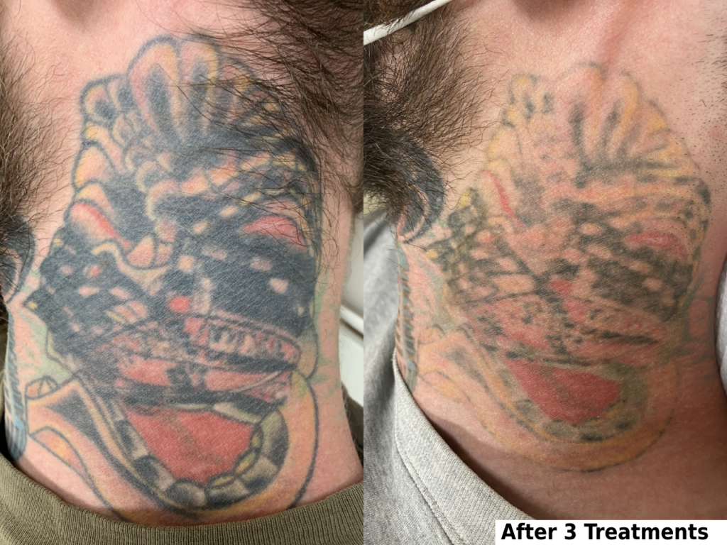 How to remove a tattoo completely