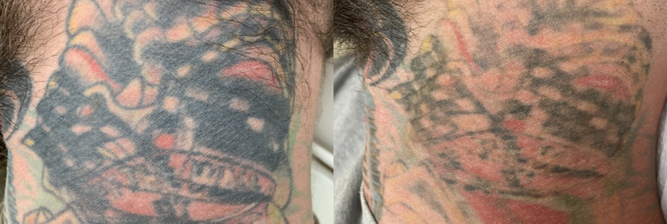 tattoo removal denver Archives - Black Sage Laser Tattoo Removal