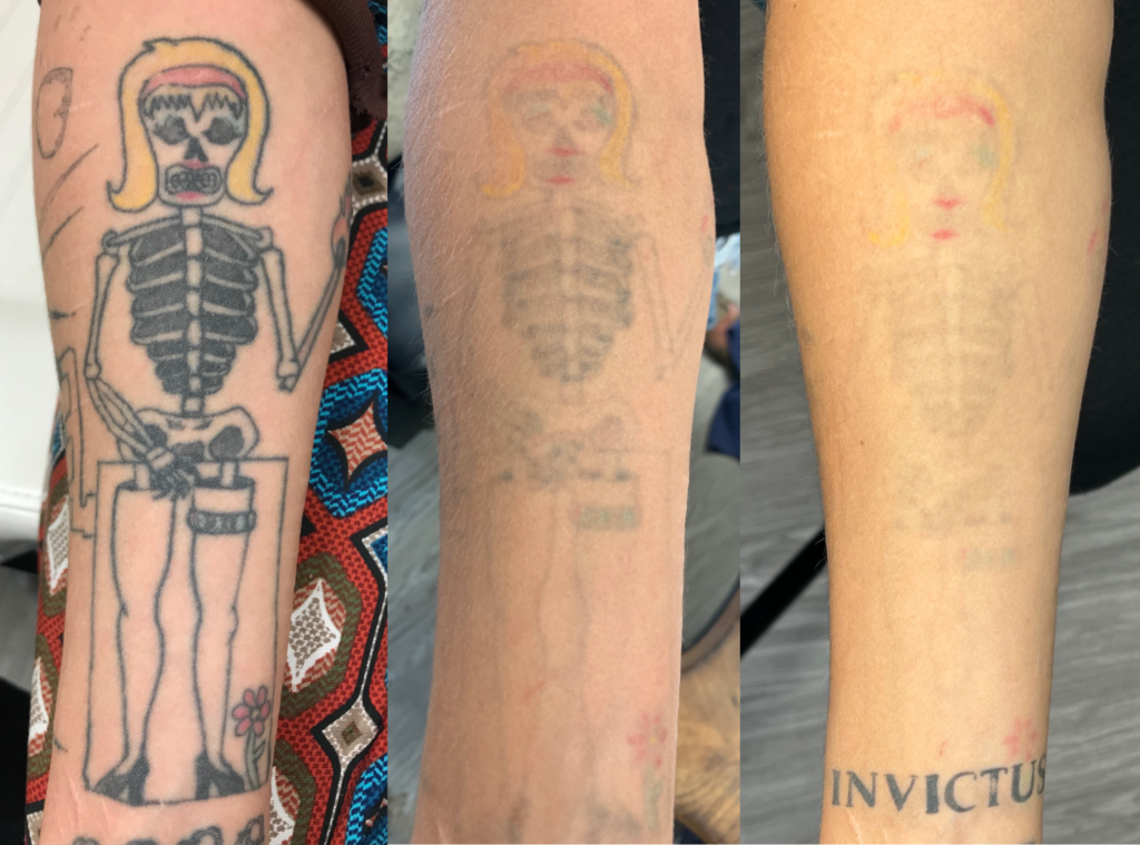 How laser tattoo removal works, tattoo removal aftercare