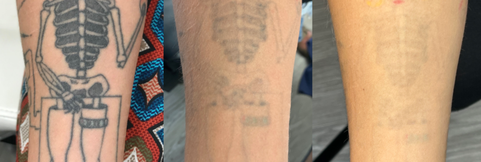 tattoo removal denver Archives - Black Sage Laser Tattoo Removal