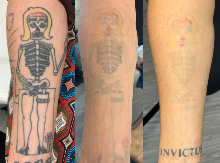 How laser tattoo removal works