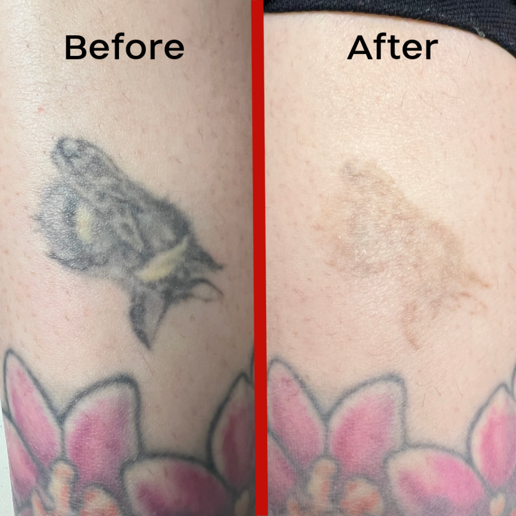 How long laser tattoo removal takes