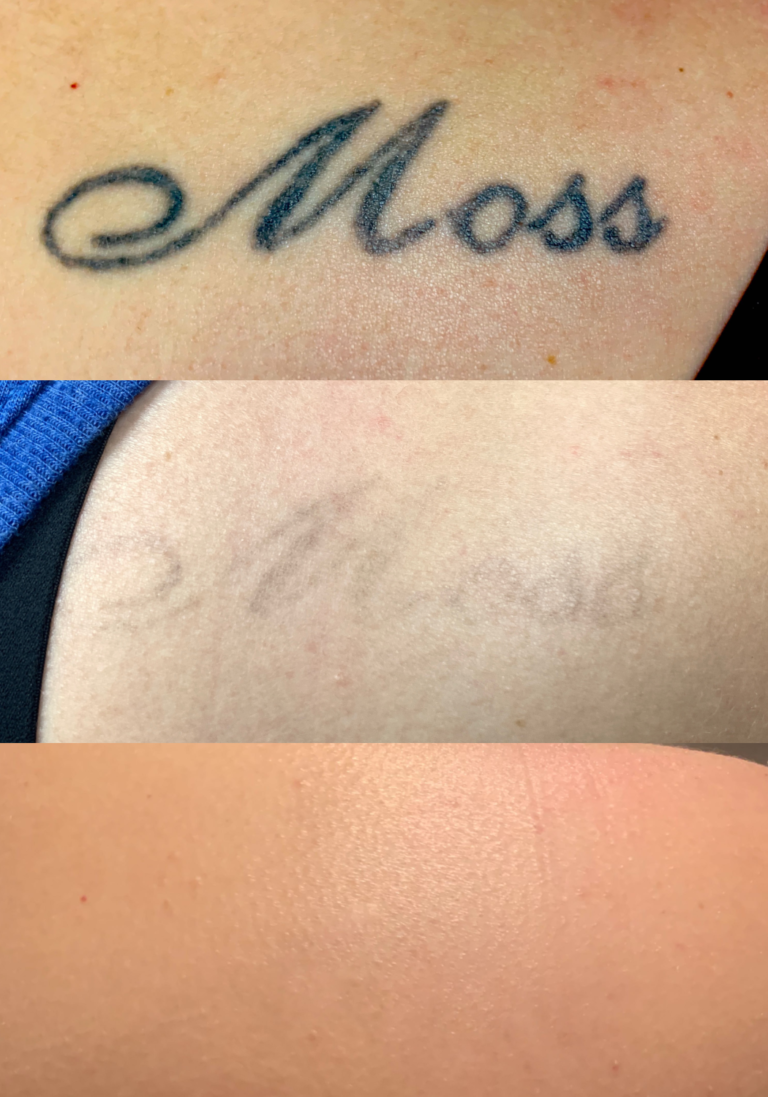 how tattoo removal works, tattoo removal options, tattoo removal portfolio