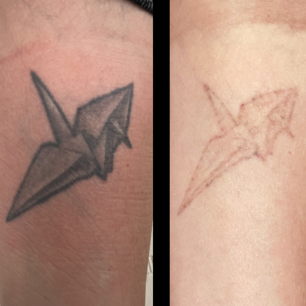laser tattoo removal after 2 treatments