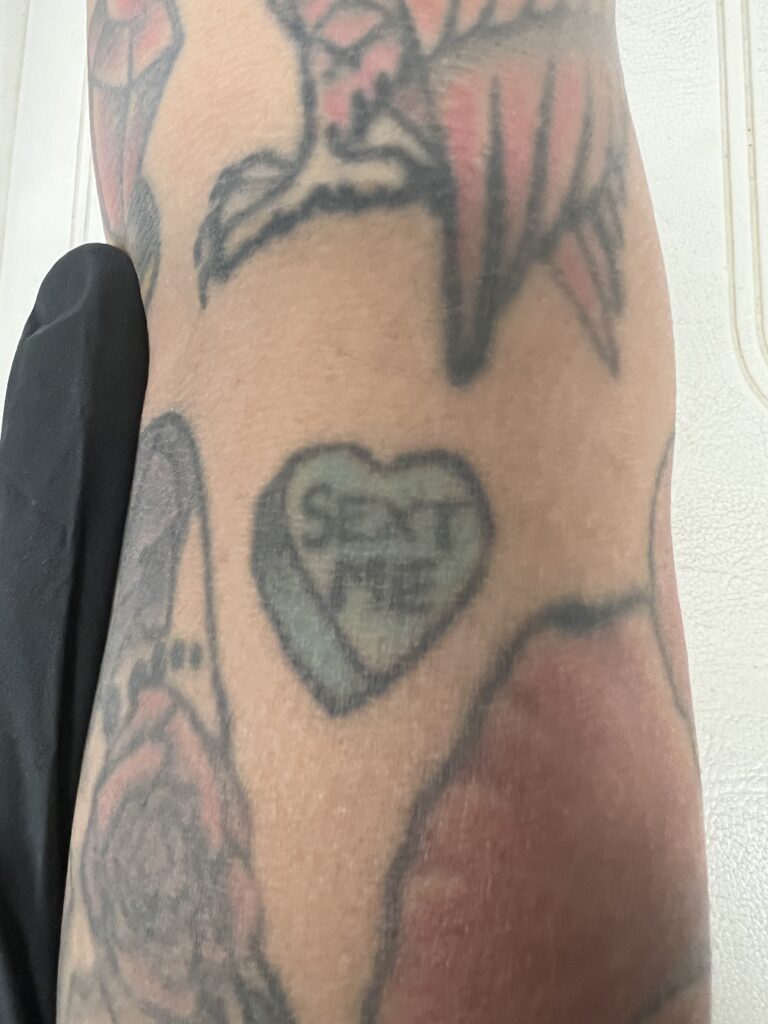 targeting words inside a candy heart, laser tattoo removal