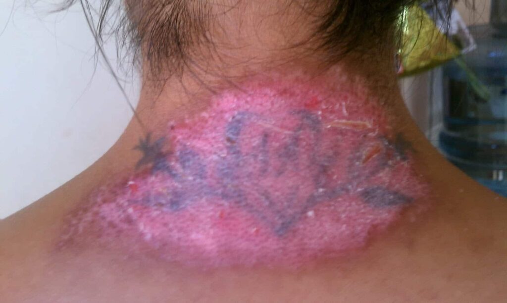 Salibrasion tattoo removal results