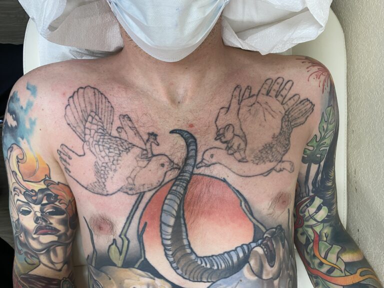 Milo Afring, laser tattoo coverup, 2 treatments