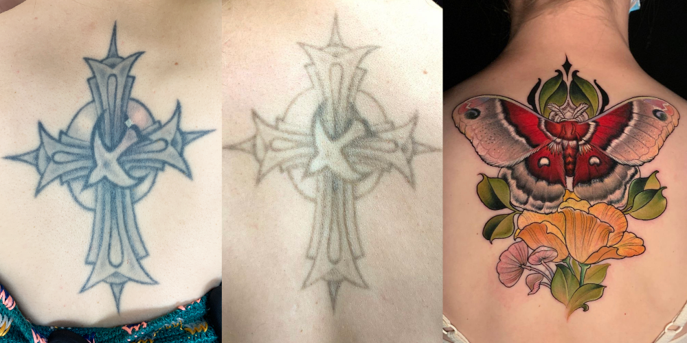 tattoo removal portfolio, tattoo removal before and after, tattoo removal coverup