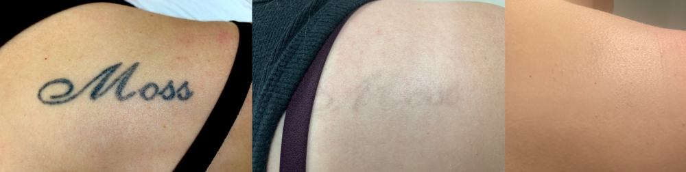 laser tattoo removal sessions