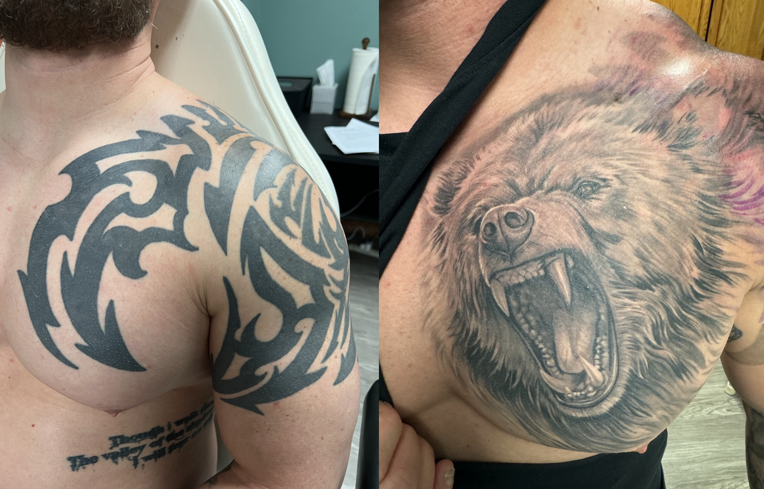 laser tattoo removal colorado